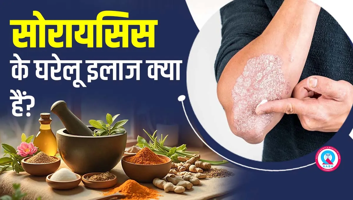 सोरायसिस-के-घरेलू-इलाज-क्या-हैं